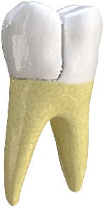 Treatment in Arlington Heights, IL for when a portion of the tooth splits off entirely. Fractured Cusp in Arlington Heights, IL