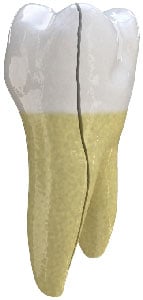 Treatment for split tooth in Arlington Heights, IL Split Tooth in Arlington Heights, IL