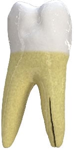 Treatment for fracture of tooth that starts at root extending to crown in Arlington Heights, IL Vertical Root Fracture iin Arlington Heights, IL