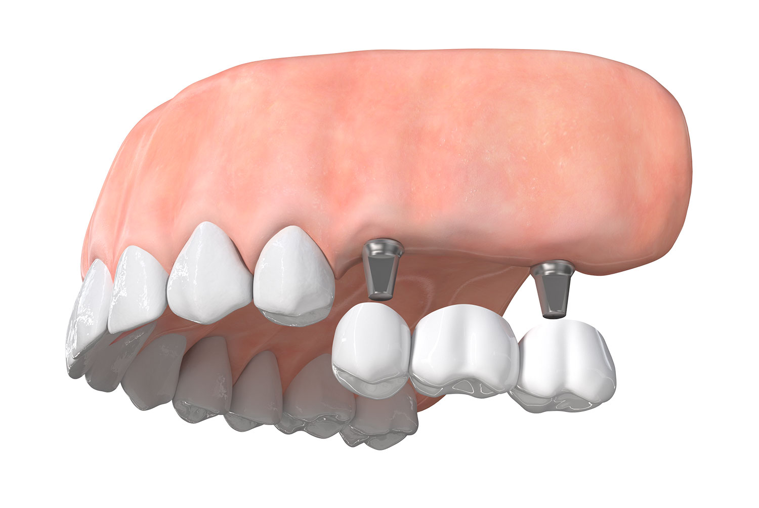 Multiple Teeth Implants