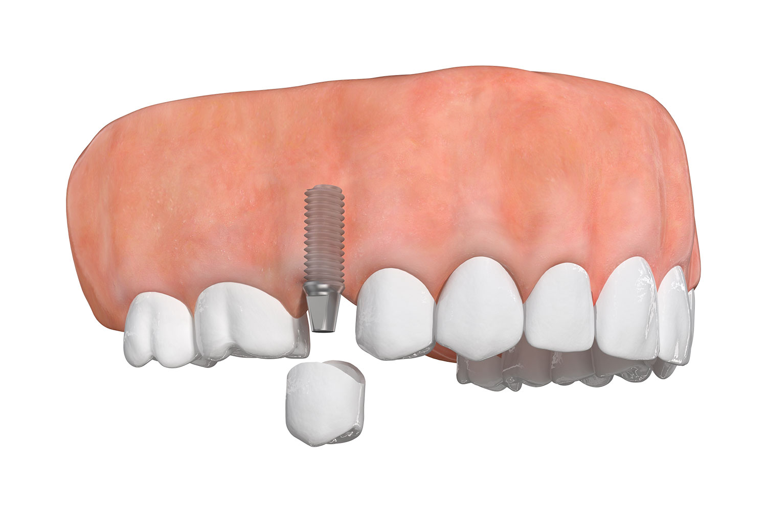 Single Tooth Implant