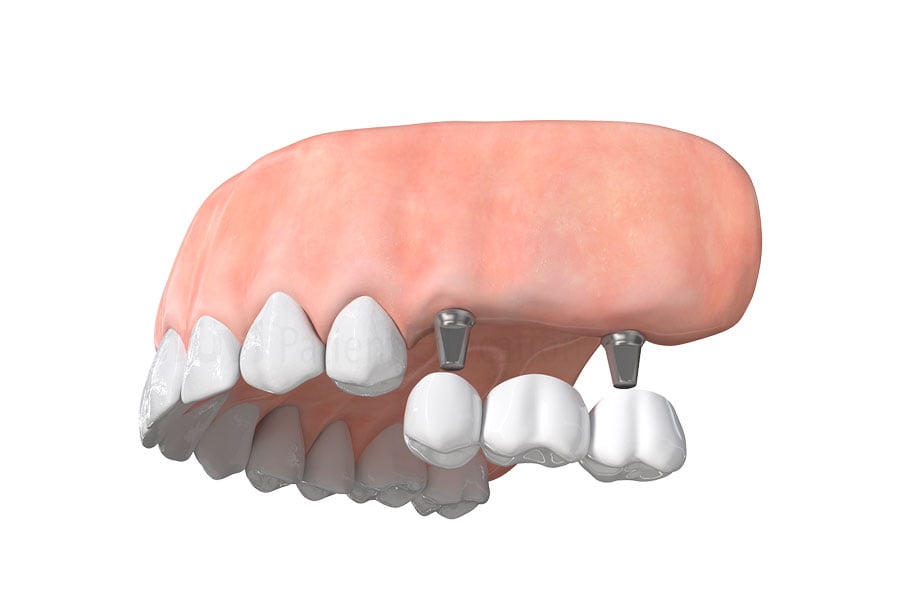 Dental Implant Bridge in Arlington Heights, IL