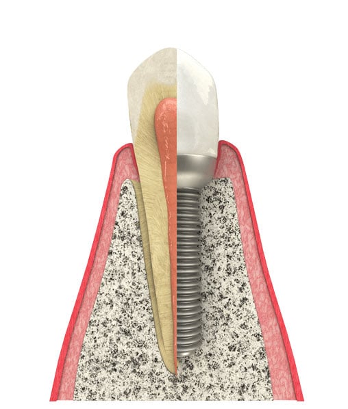 The benefits of dental implants are extensive, correct your smile in Arlington Heights, IL. Benefits of Dental Implants in Arlington Heights, IL
