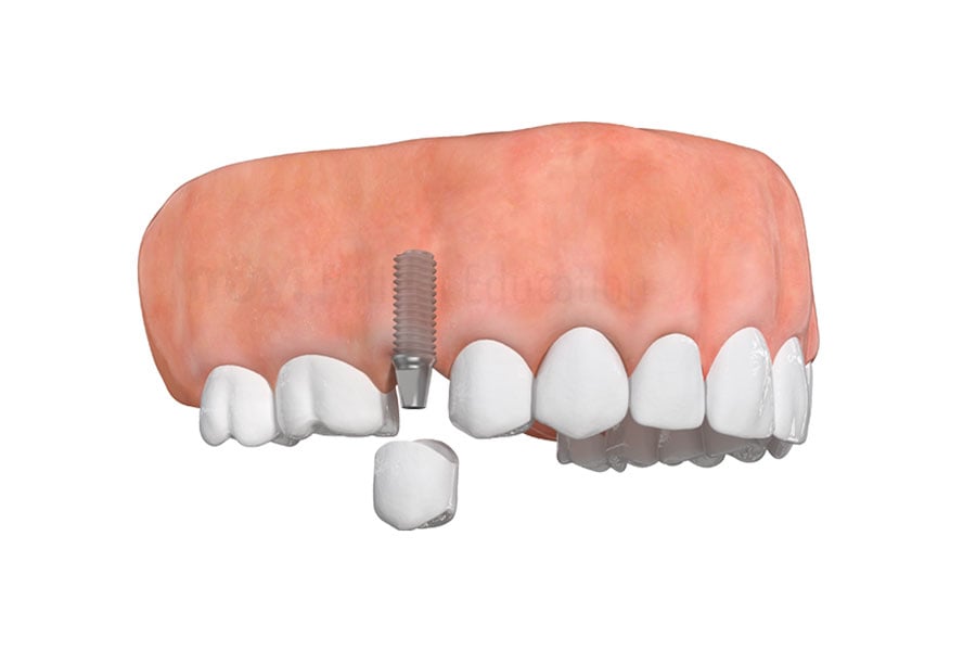 Correct an imperfect smile with dental implants near Arlington Heights, IL. Dental Implants in Arlington Heights, IL
