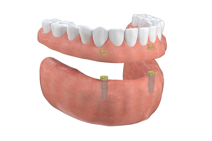Implant-Supported Overdentures in Arlington Heights, IL