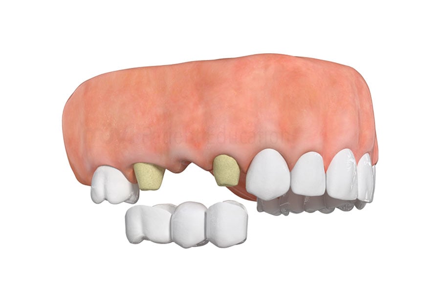 Traditional dental bridge is a great option to correct teeth near Arlington Heights, IL. Traditional Bridge in Arlington Heights, IL