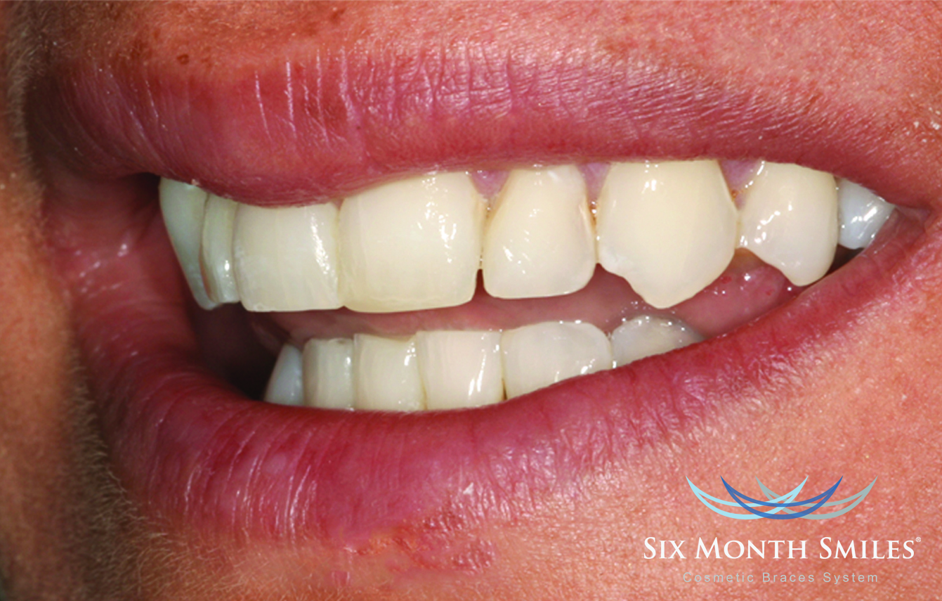 Before & After Dental Transformations in Arlington Heights, IL.