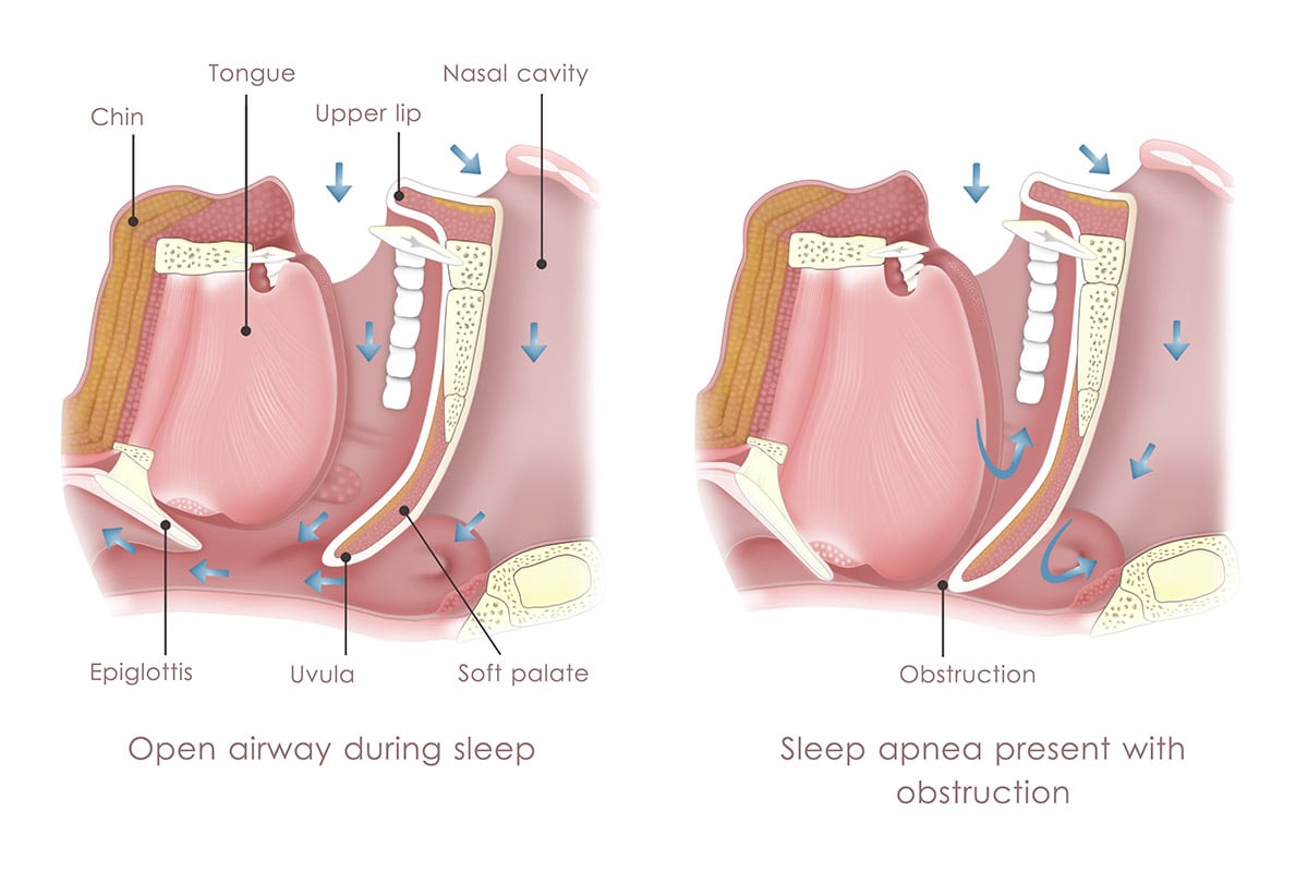 Sleep Apnea in Arlington Heights, IL.