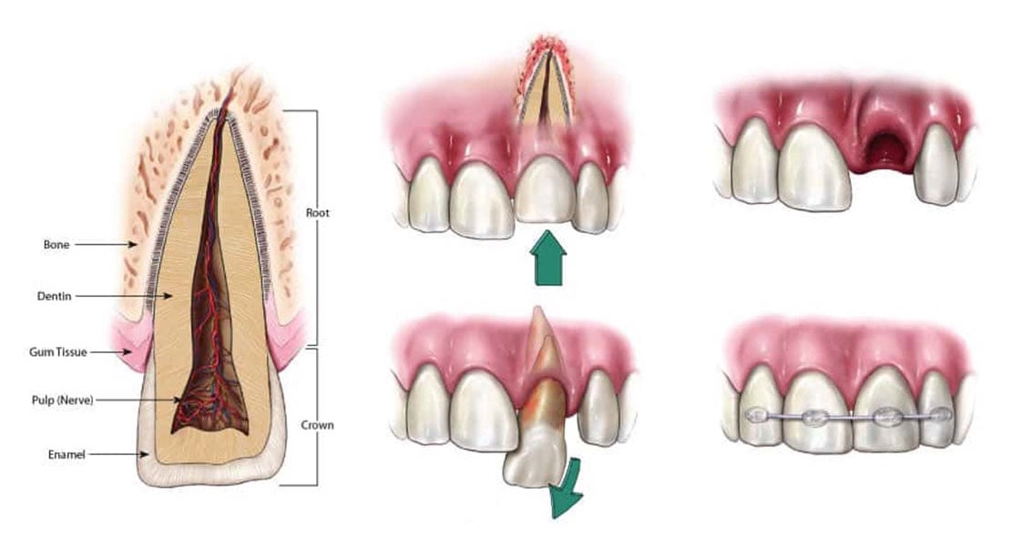 Learning what is considered a traumatic dental injury in Arlington Heights, IL. Traumatic Injuries in Arlington Heights, IL.
